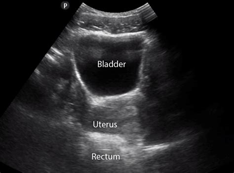 bladder scan results interpretation|Ultrasound of the Urinary Tract .